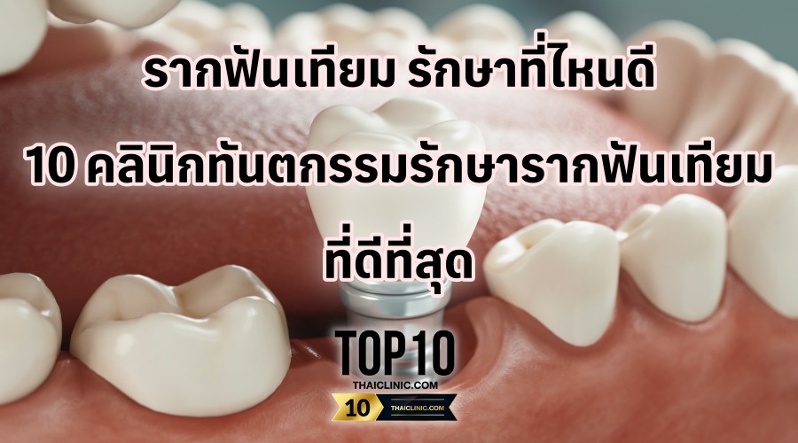 รากฟันเทียม รักษาที่ไหนดี 10 คลินิกทันตกรรมรักษารากฟันเทียม ที่ดีที่สุด